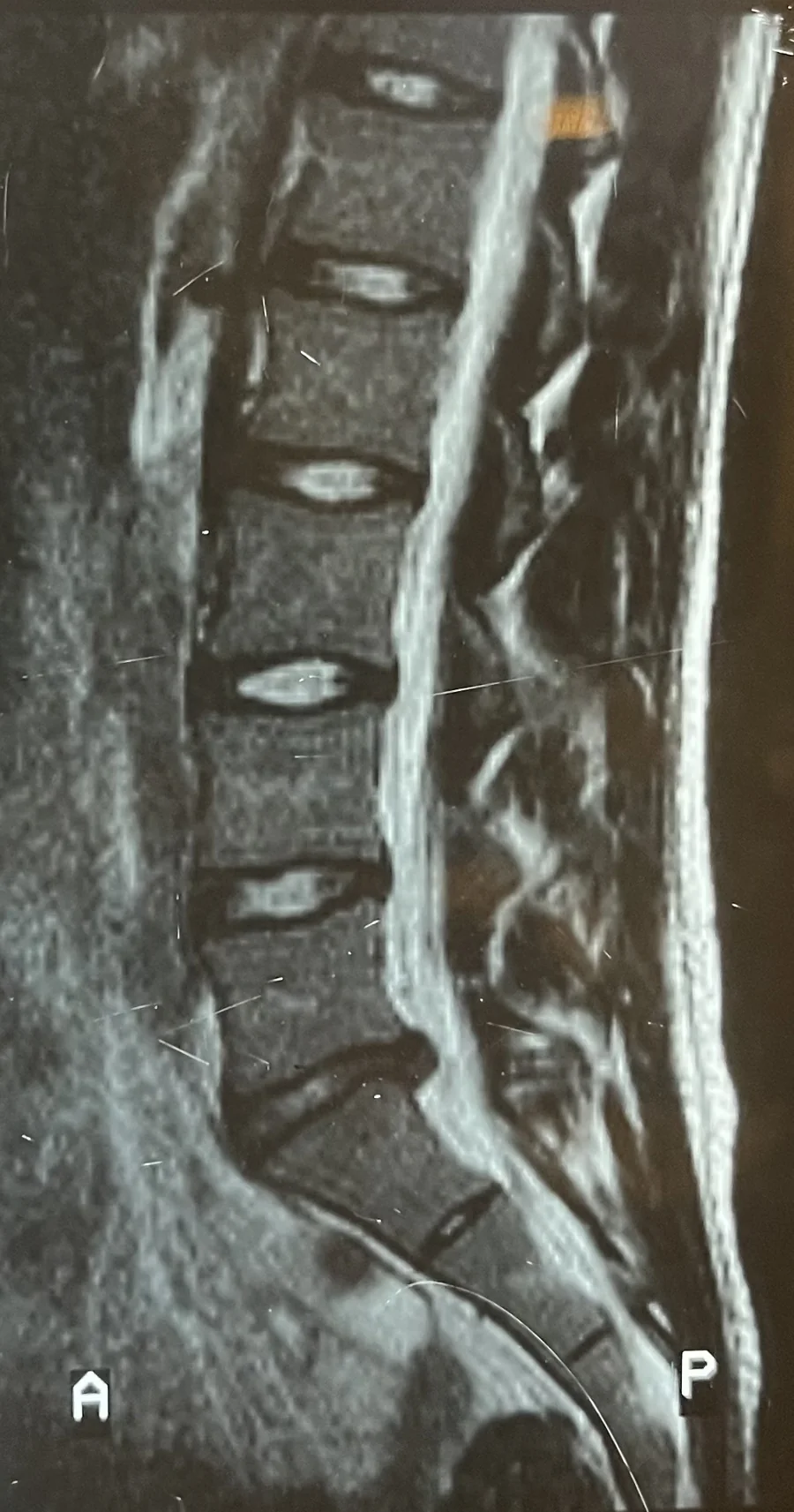 Ressonância magnética da coluna lombar de Leonardo Schneider, em corte de perfil, feita em julho de 2001
